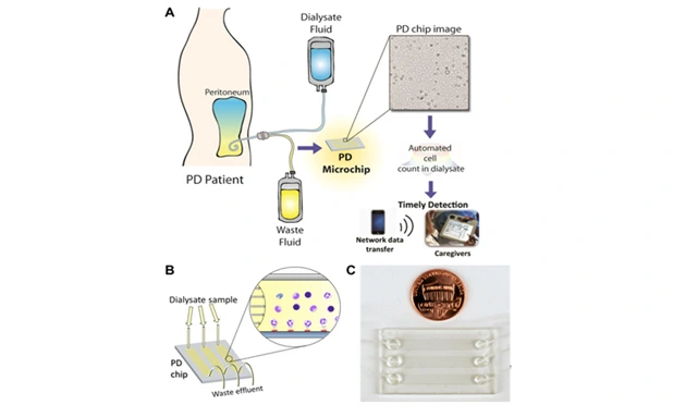 Preview of Detection of Peritonitis in Patients on Peritoneal Dialysis at Home